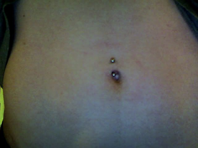 Keloid. Navel+piercing.